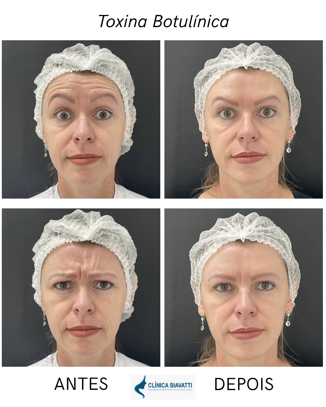 Antes e depois de toxina botulínica — caso 1