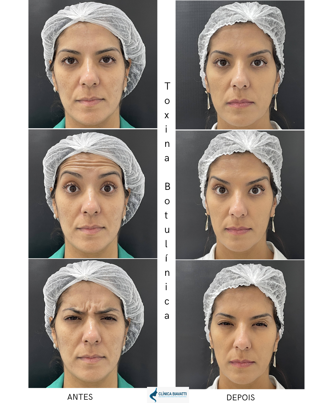 Antes e depois de toxina botulínica — caso 2